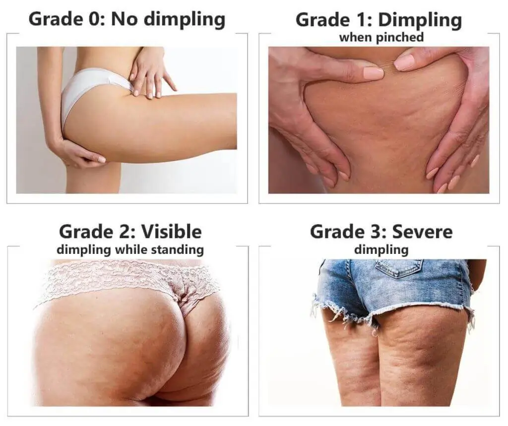 Representation of the stages of cellulite development Reigate